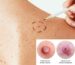 ¿Cómo prevenir el cáncer de piel?